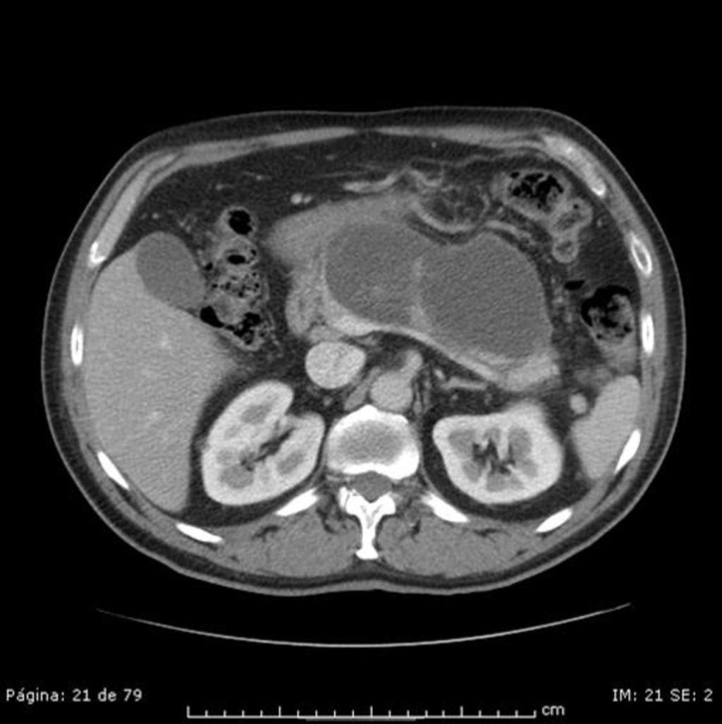 Fig. 7: Pseudoquiste pancreático.
