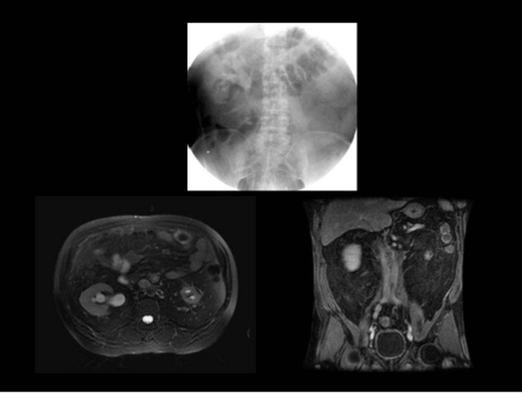 Fig. 3: Varón de 55 años con fibrosis retroperitoneal idiopática.