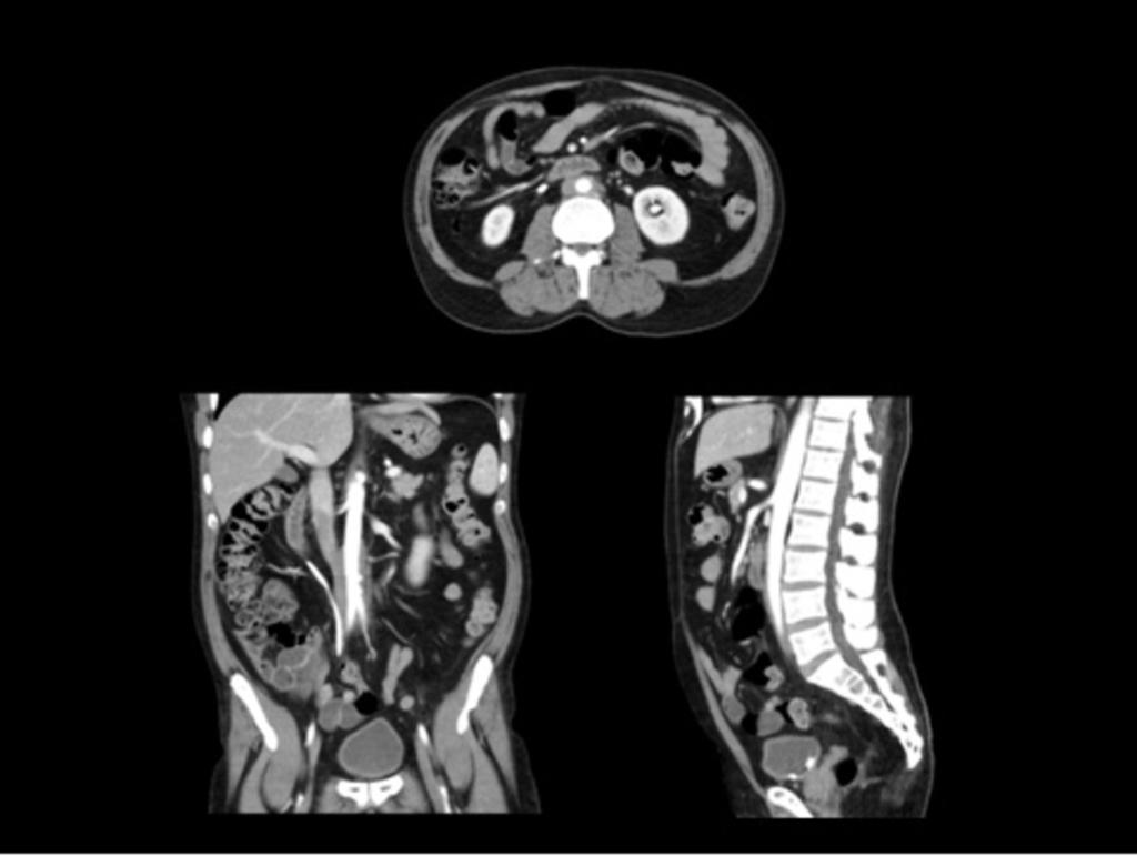 Fig. 4: Corte axial de TC con reconstrucción coronal y sagital de un varón de 50 años con fibrosis retroperitoneal.