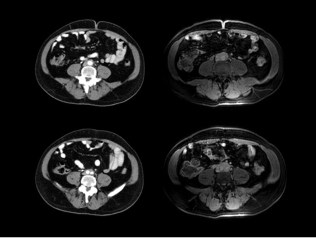 Fig. 6: Imagen comparativa de TC y RM tras administración de contraste, realizada a un varón de 44 años con fibrosis retroperitoneal.