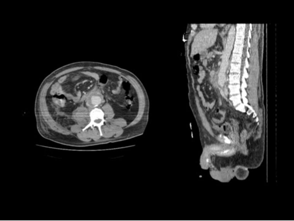 Images for this section: Fig. 1: Varón de 55 años con dolor abdominal.