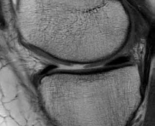 autólogo para tratar lesiones es de la rodilla Figura 3. Resonancia magnética. Lesión (flecha). Figura 4. Seguimiento radiográfico. autólogo asociado a osteotomía valguizante.