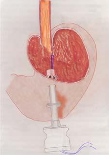 Funduplicatura laparoscópica transgástrica intraluminal, estudio pre-clínico realiza bajo anestesia general, se introduce a la cavidad gástrica un trócar de 10 mm
