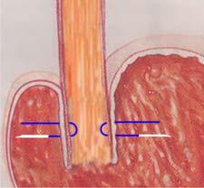 La unión escamo-columnar (EC) es la clave visual que marca el territorio durante la endoterapia para el ERGE y corresponde al punto medio del esfínter esofágico