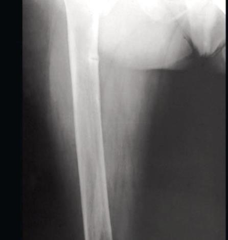 Osteomalacia Enfermedad del metabolismo óseo que consiste en déficit de mineralización del hueso.
