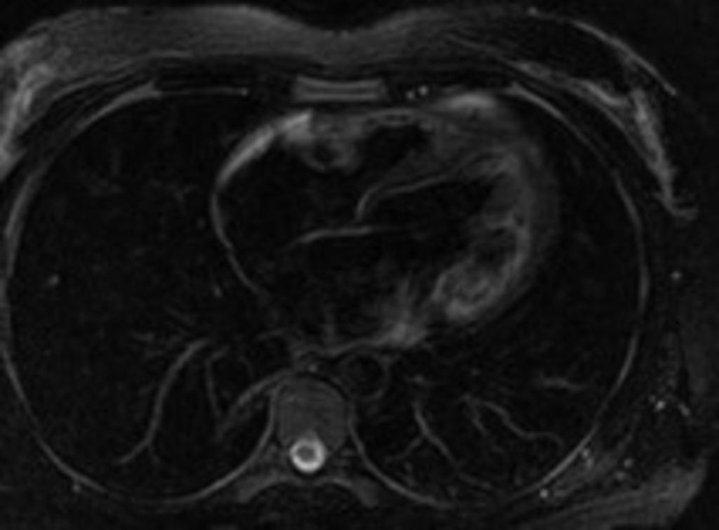 Fig. 15: Imagen 4C sangre negra T2 FAT SAT.