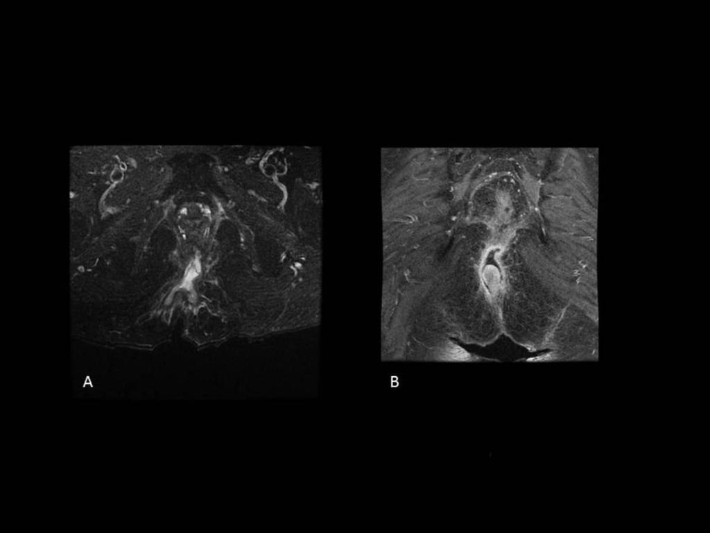 Fig. 5: Imagen RM axial al canal anal T2 fat sat (A) e imagen RM coronal T1 fat sat con contraste (B) que muestra fístula grado 4 de la clasificación de Saint Jame's secundaria a proctitis actínica.