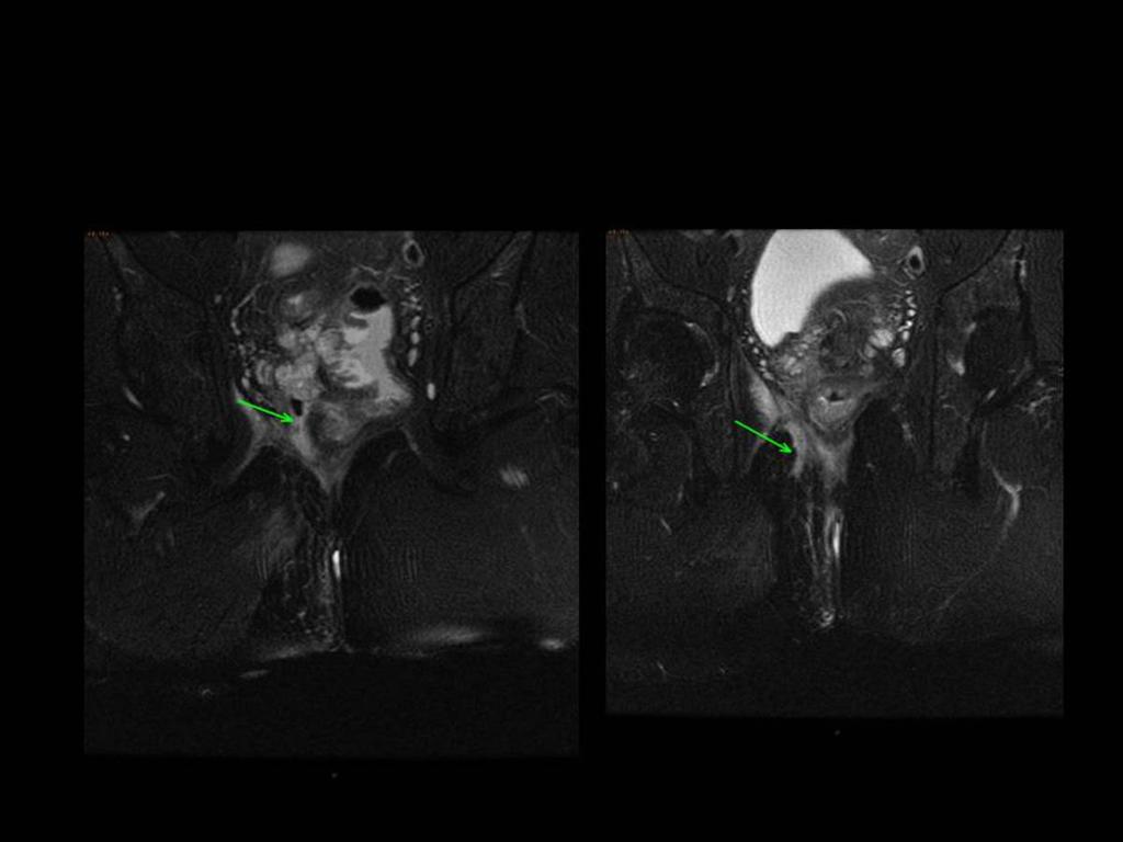 Fig. 8: Imagen RM coronal T2 fat sat de dos cortes consecutivos que muestra fístula grado 5 de la clasificación de Saint James en paciente con cáncer de recto.