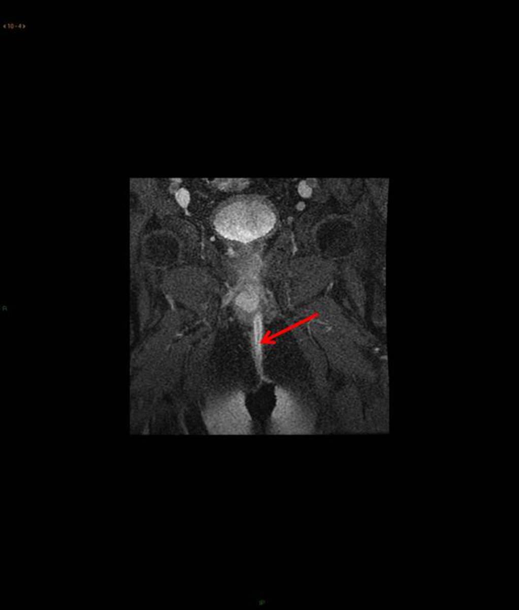 Fig. 3: Imagen coronal de RM T1 fat sat con contraste del mismo paciente de la figura 2 que muestra realce de la fístula interesfinteriana (flecha roja) que no