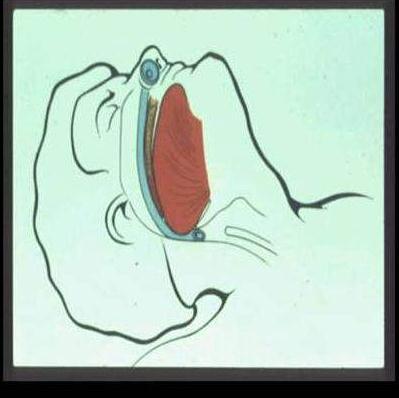 4. Inserte la cánula nasofaríngea: Empuje suavemente la punta de la nariz hacia arriba. Posicione la cánula de forma que el bisel apunte hacia el septum.