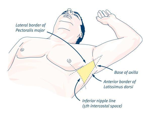 3. Inserte el tubo: Haga una incisión transversal de 2 a 3 cm en el sitio seleccionado y extiéndala hasta los músculos intercostales.