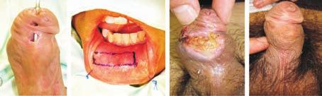 Uso de Injertos Libres Figs 11,12,13,14. Paciente con múltiples fístulas, corregido con injerto libre de mucosa bucal. Presentó necrosis parcial de piel, que resolvió con manejo conservador.
