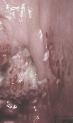 Cancer Cervical, imagen real diferentes opciones de histerectomía: PIVER I: con resección de cúpula.