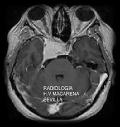 La cirugía de los meningiomas ha reflejado más que la de ningún otro tipo de tumor, los progresos, problemas y desarrollo de técnicas en nuestra