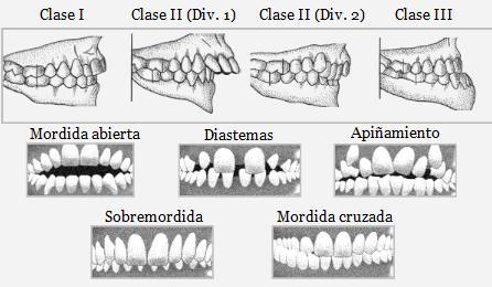 - Anomalías en la forma de los dientes - Frenillo labial anormal, barreras mucosas - Pérdida prematura de dientes - Retención prolongada de dientes - Brote tardío de los dientes - Vía de brote