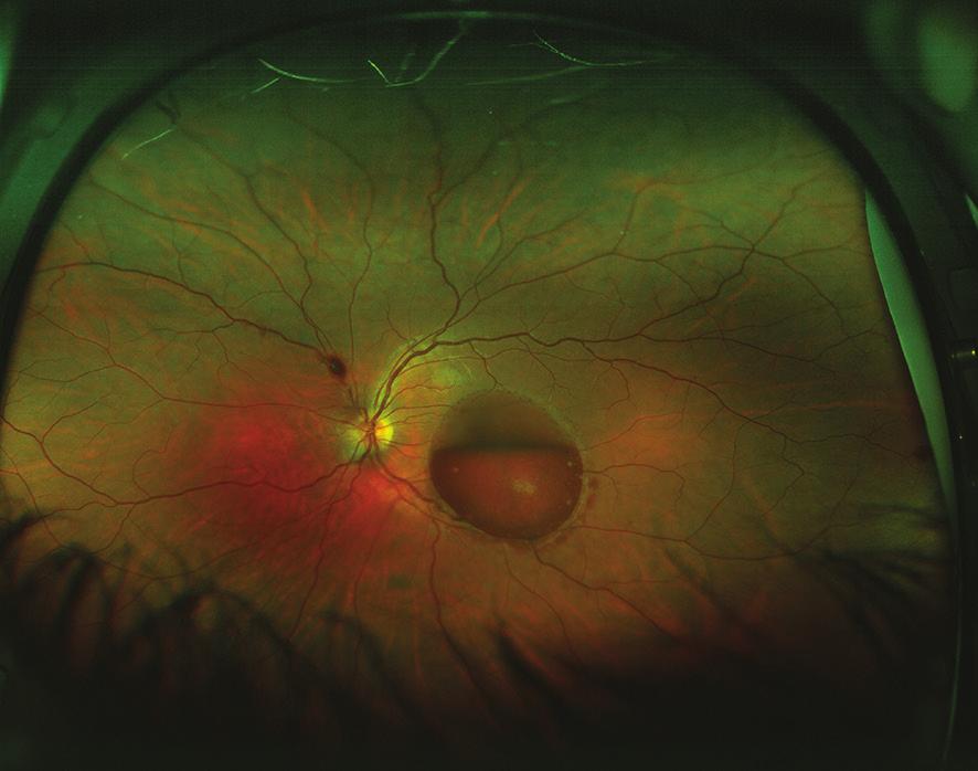 Rev Mex OftalMOl. 2018;92 2 Introducción La hemorragia premacular en un ojo previamente sano es una causa poco frecuente de disminución de la agudeza visual (AV).