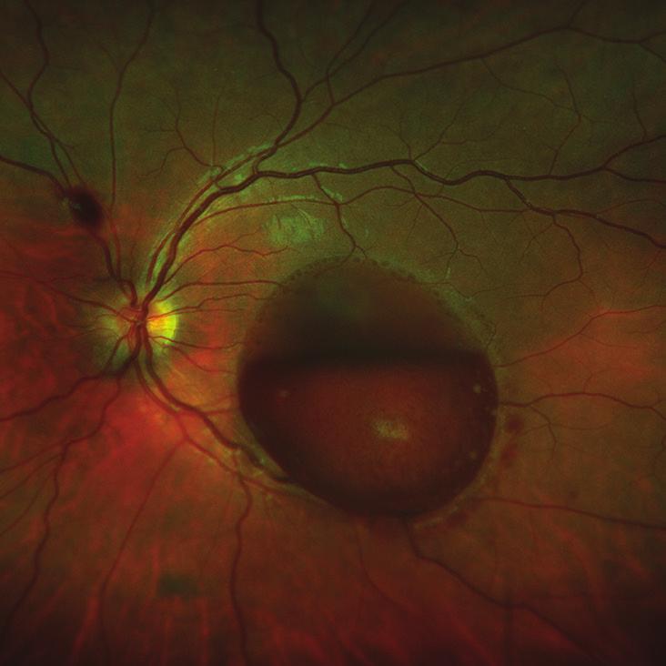 macroaneurisma retiniano y por retinopatía de Valsalva (RV) 1.