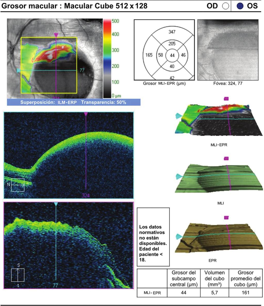 J.A. Fajardo-Sánchez, et al.: Retinopatía de Valsalva secundaria Figura 3. OCT macular que corresponde a la hemorragia premacular vista en retinografías previas.
