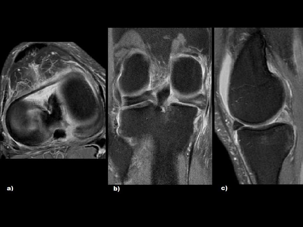 Fig. 4: a), b) y c)- Rotura radial completa con desplazamiento con afectación de la raíz del cuerno posterior del menisco interno. RM axial, coronal y sagital en DP con SG.