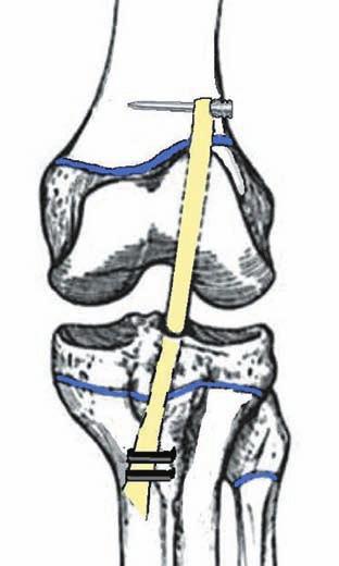 Figura 2: Técnica quirúrgica de la reconstrucción LCA transfisiaria.