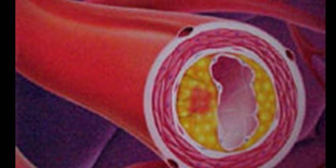 MÓDULO 2 FACTORES DE RIESGO CARDIOVASCULAR Como se destruyen las arterias? Diferencia entre arterioesclerosis y Ateromatosis.