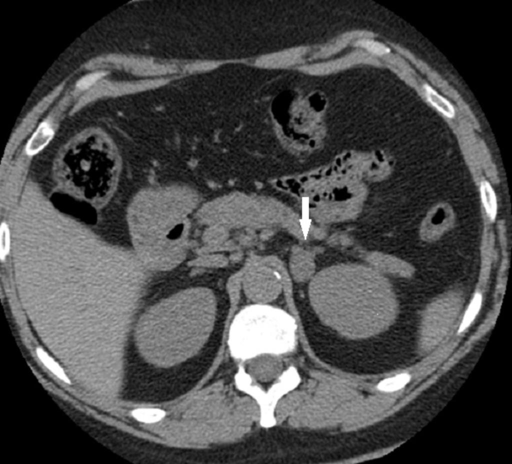Fig. 4: Paciente 2.TC abdominal sin contraste. Paraganglioma suprarrenal izquierdo. Mujer de 47 años con VHL.