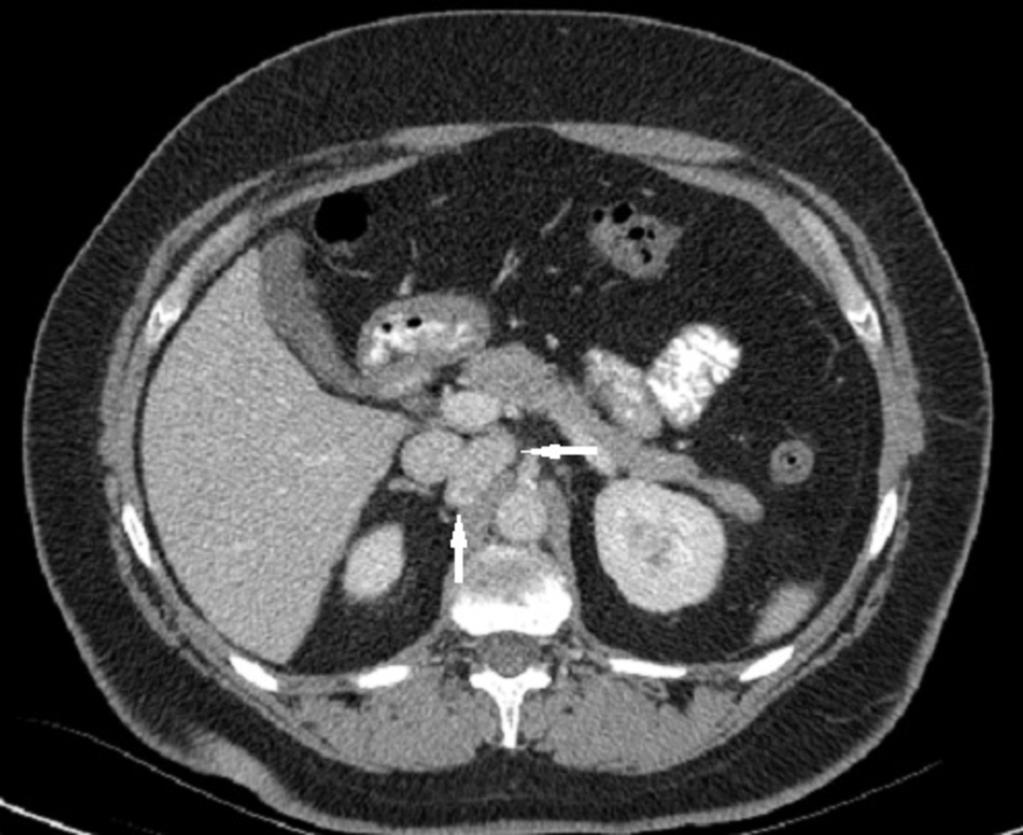 Fig. 5: Paciente 2. TC abdominal con contraste intravenoso. Paraganglioma retroperitoneal derecho.mujer de 47 años con enfermedad VHL.