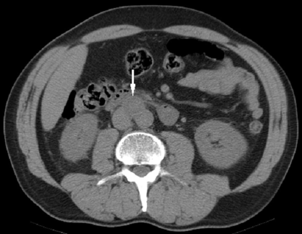 Fig. 6: Paciente 3. TC abdominal sin contraste. Paraganglioma interaortocava.