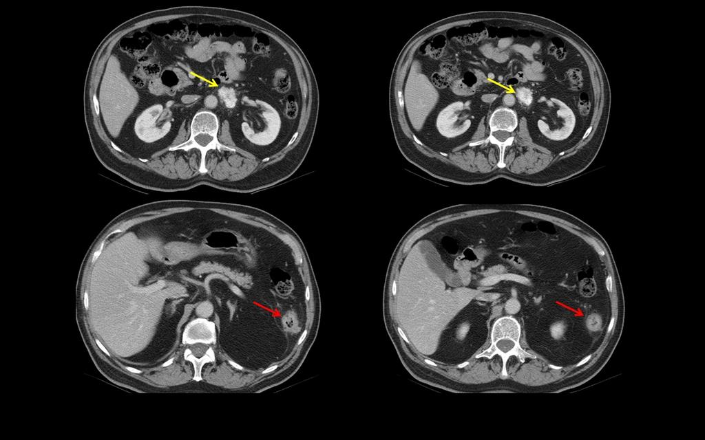 Fig. 9: Paciente 4.TC abdominal con contraste intravenoso. Paraganglioma extraadrenal para-aórtico izquierdo invasivo (flechas amarillas).