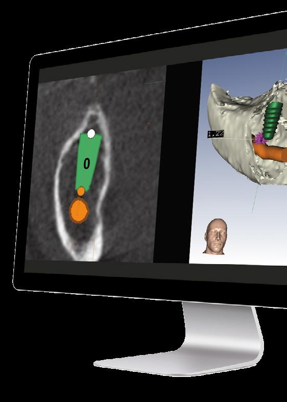 Precisión y facilidad Simulación de implantes dentales en 3D.