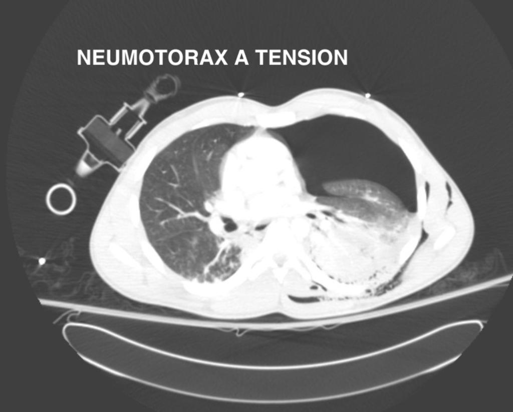- pneumotórax a tensión: pese a que puede diagnosticarse clínicamente los signos radiológicos que hacen sospecharlo son, el desplazamiento