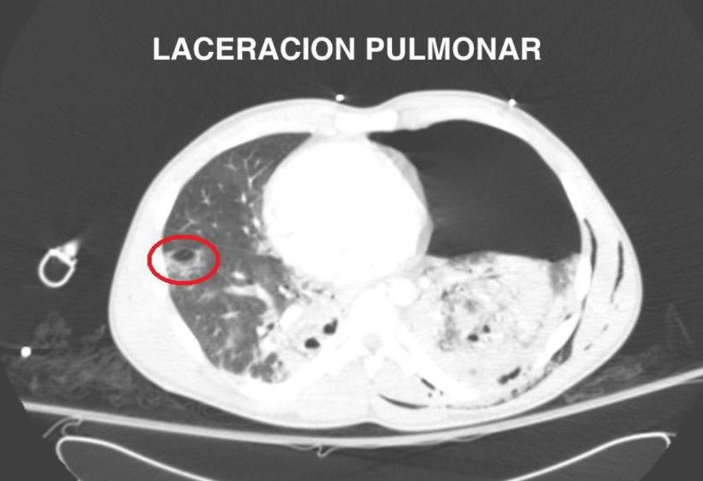 . tipo 4: adyacente a una adhesión pleuro-pulmonar previa. Fig. 15:. Atelectasias.