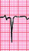 La anomalía electrocardiográfica más común es la onda T negativa en las derivaciones V1 a V3, que se halla en hasta el 50% de los afectados, variable según las distintas series.