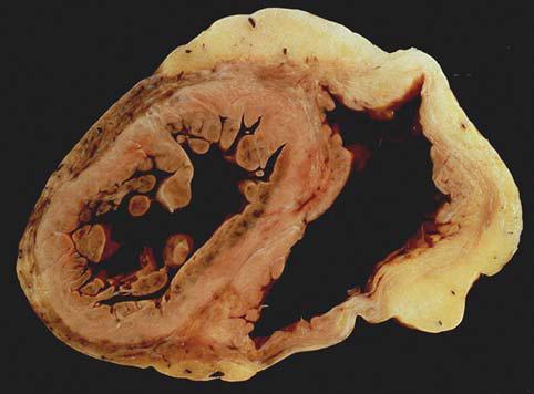 ANATOMÍA PATOLÓGICA Macroscópicamente se observa un ventrículo derecho dilatado con protrusiones de la pared en las zonas infundibular, apical y subtricuspídea (triángulo de la displasia).