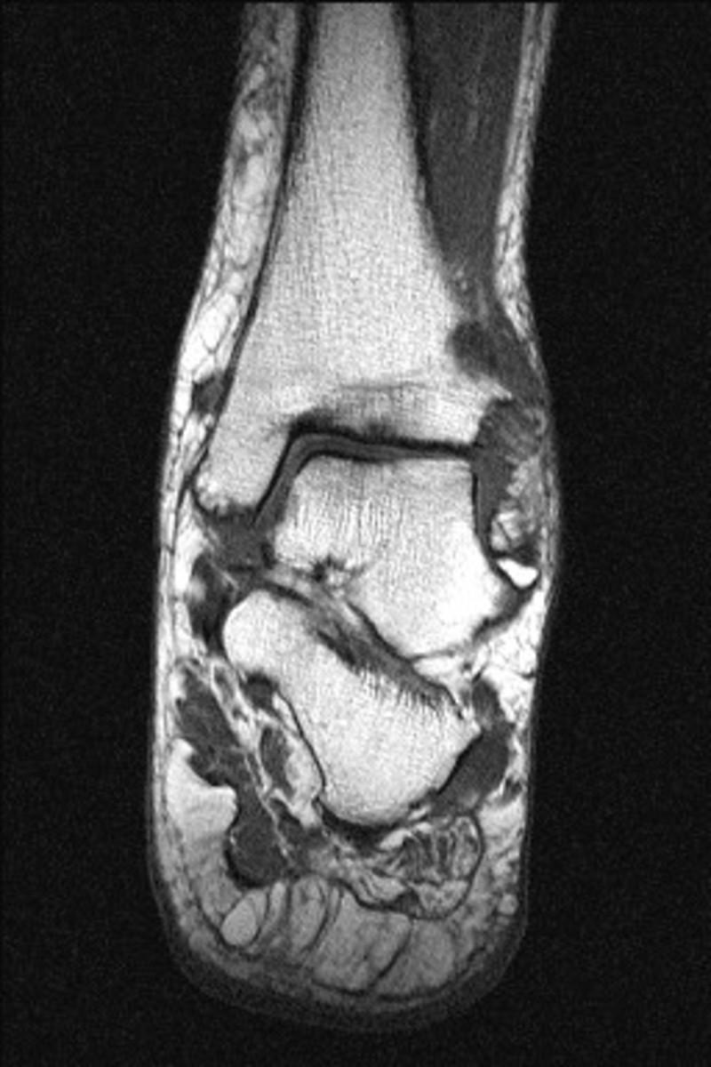 Fig. 8: T1 coronal tobillo. Pie doloroso en paciente corredor de media distancia.
