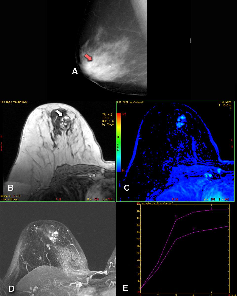 Fig. 6: (A) Proyección medio lateral oblicua mamográfica en la que se observa una distorsión de la arquitectura (flecha roja) que corresponde a una LEC.