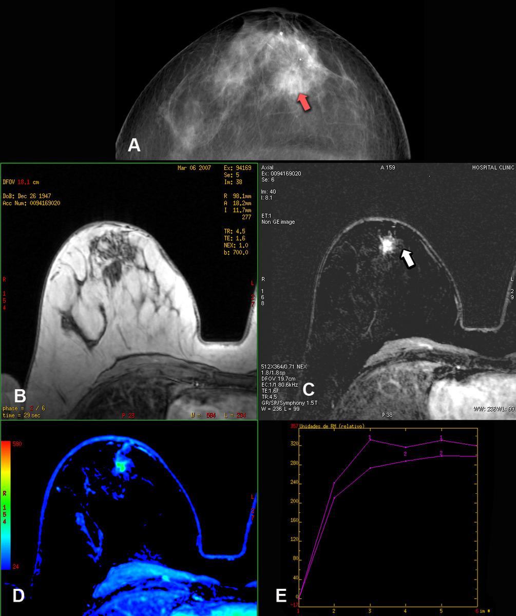 Fig. 2: (A)Proyección craneocaudal de mamografía en la que se observa (flecha roja) una distorsión de la arquitectura parenquimatosa correspondiente a una LEC.