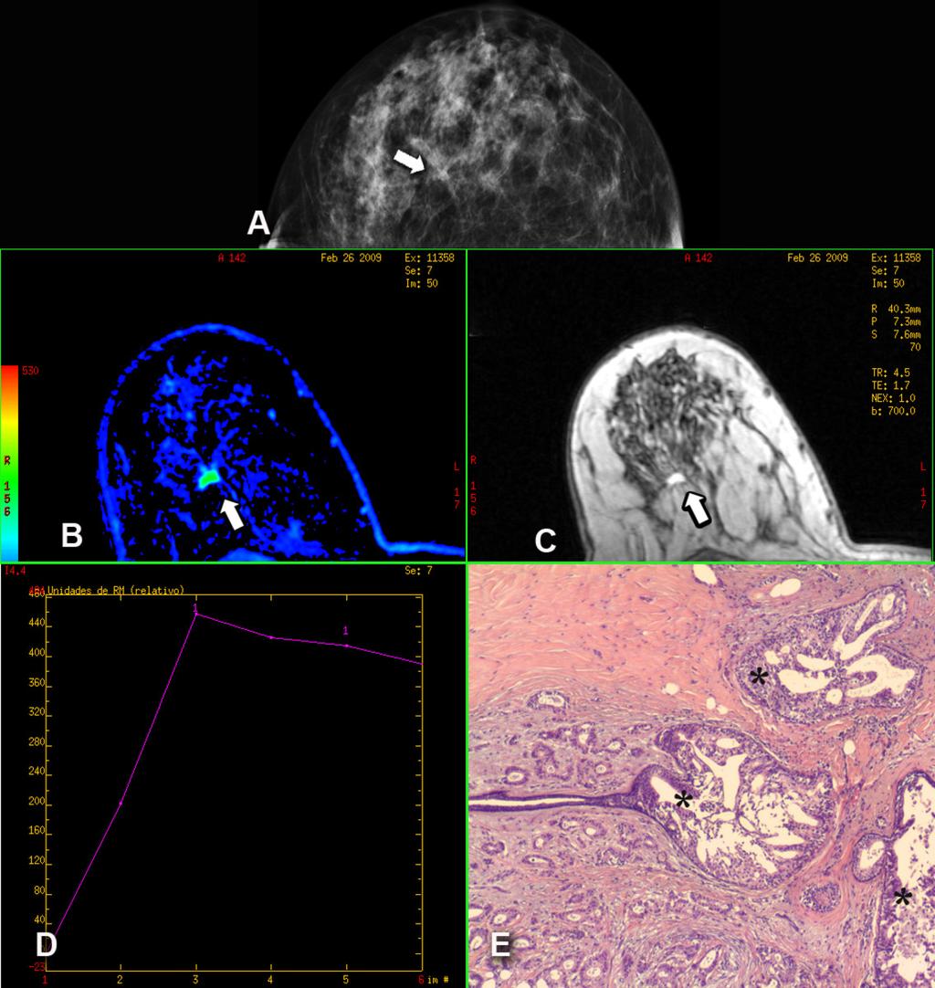 Fig. 4: (A) Proyección craneocaudal de mamografía en la que se muestra una distorsión de la arquitectura del parénquima mamario (flecha), correspondiente a una LEC.