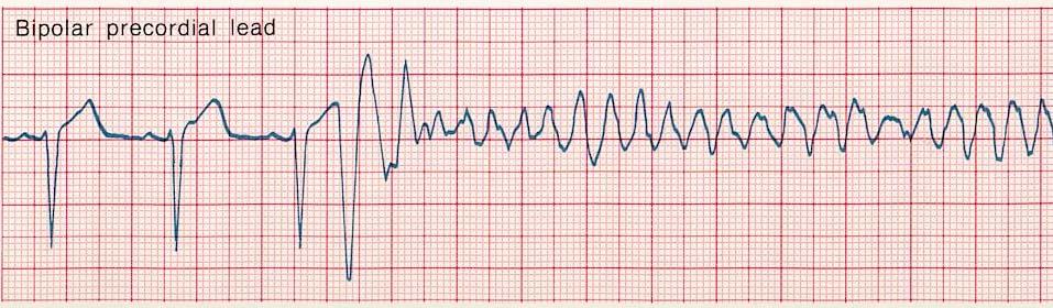 Definición: FIBRILACION VENTRICULAR Estado de despolarización ventricular descoordinado que ocasiona un débito cardíaco no efectivo.es raro en niños.