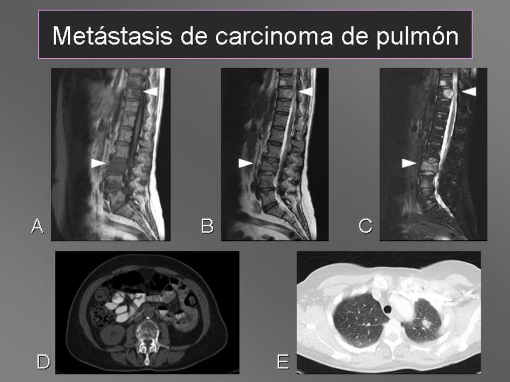 Fig. 9: Metástasis óseas líticas de carcinoma de pulmón con una señal