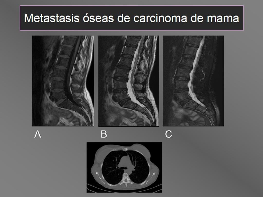 Fig. 10: Metástasis óseas blásticas de carcinoma de mama con señal hipointensa difusa de las