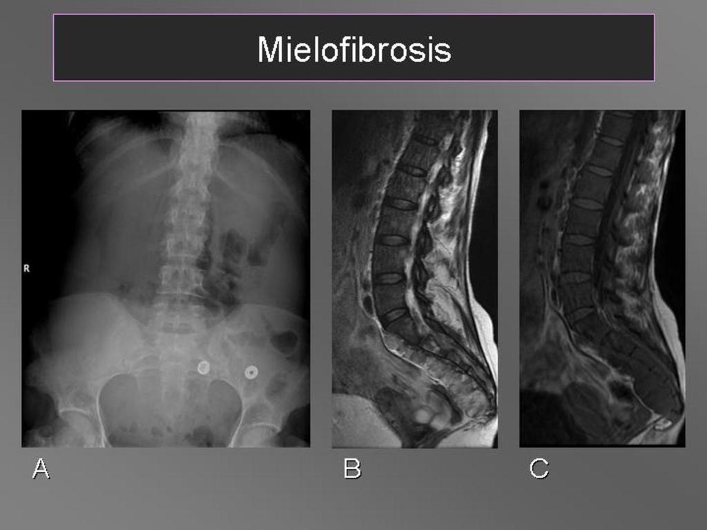 Fig. 14: Mielofibrosis idiopática crónica.(a) Esclerosis ósea en la RX.