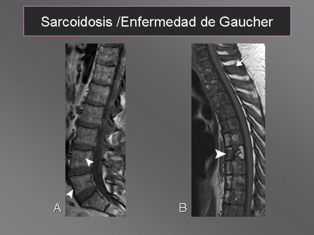 Fig. 15: Sarcoidosis(A) Patrón heterogéneo de médula ósea en T1 y lesiones óseas en L4 y L5 con un anillo de baja señal.
