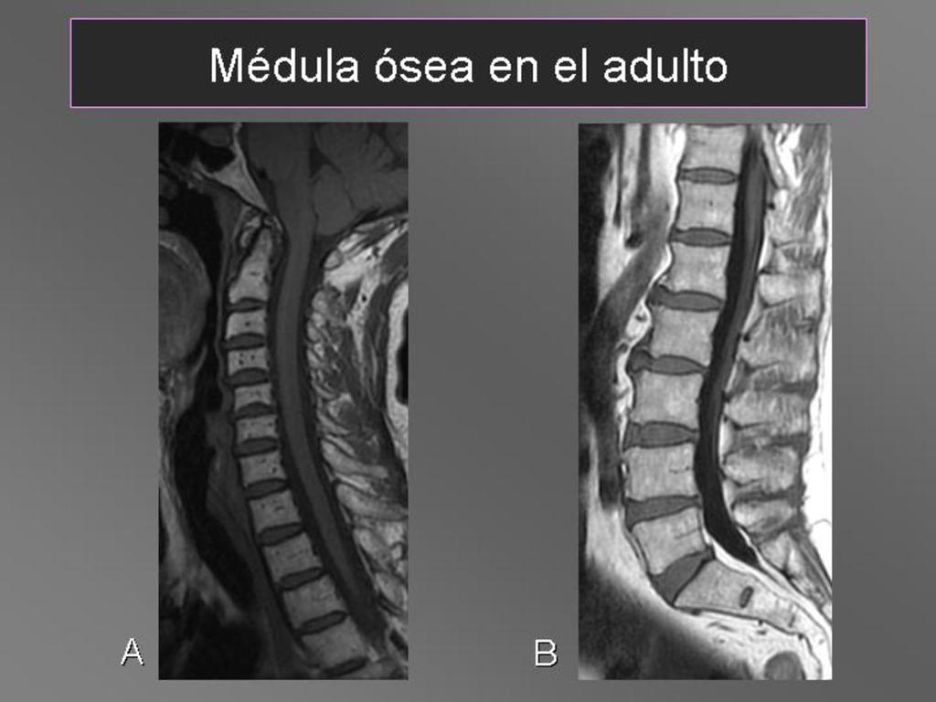 Images for this section: Fig. 1: Imagenes sagitales FSET1 de columna cervical (A) y lumbar (B).