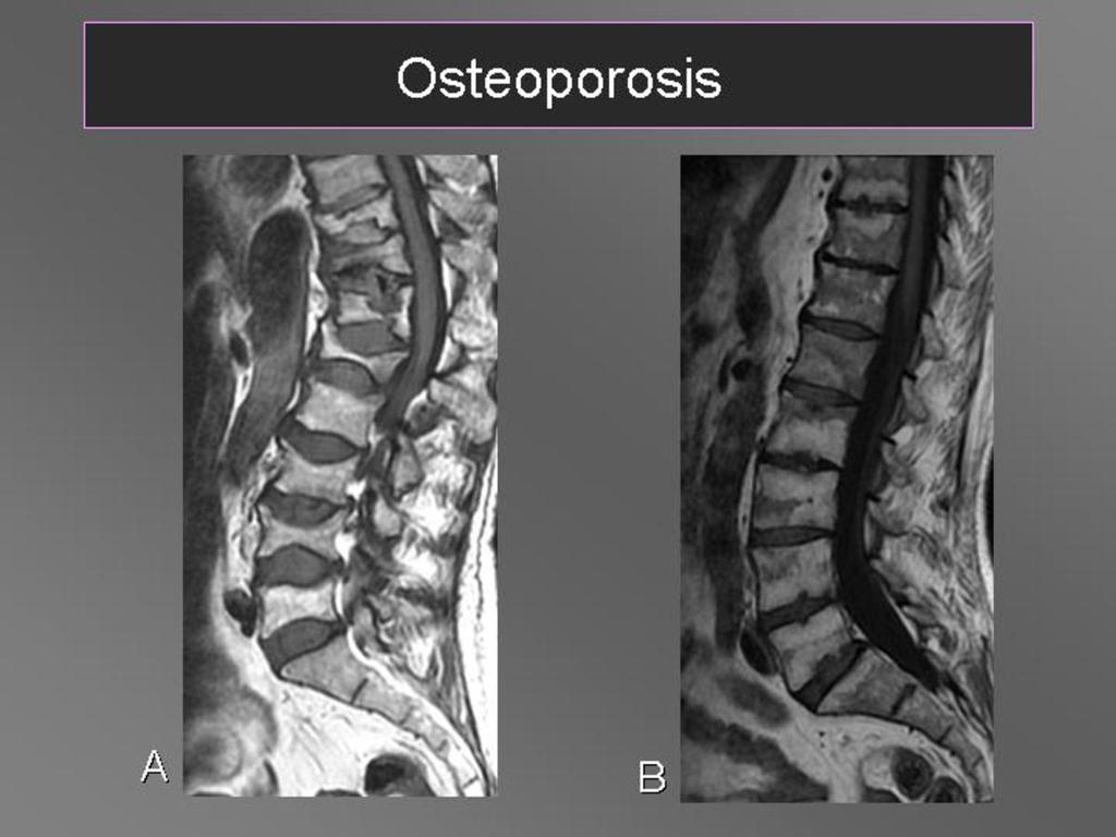 Fig. 3: Osteoporosis.(A)Infiltración grasa difusa de los cuerpos vertebrales y fracturas patológicas.