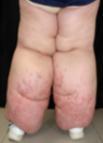 Ejemplo Dermatitis perilesional asociada al exudado (DPAE) Dermatitis cutánea asociada