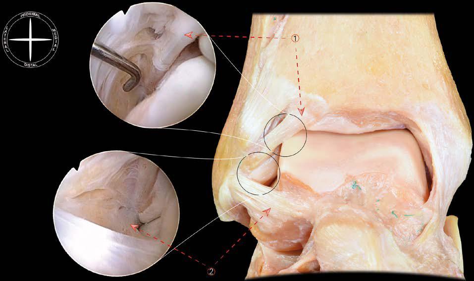 J. Torrent et al Figura 1. Localización anatómica del dolor anterolateral de tobillo por impingement de tejidos blandos. Visión anatómica y artroscópica normales.