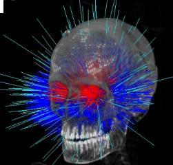 Radiocirugía CyberKnife: Indicaciones Polivalentes CRANEALES EXTRACRANEALES Metastasis Meningiomas Neurinomas MAVS