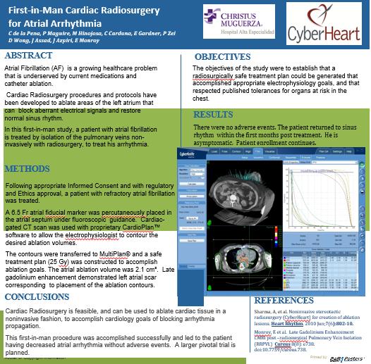 Radiocirugía CyberKnife: Corazón Fibrilacion auricular Dosis: 25
