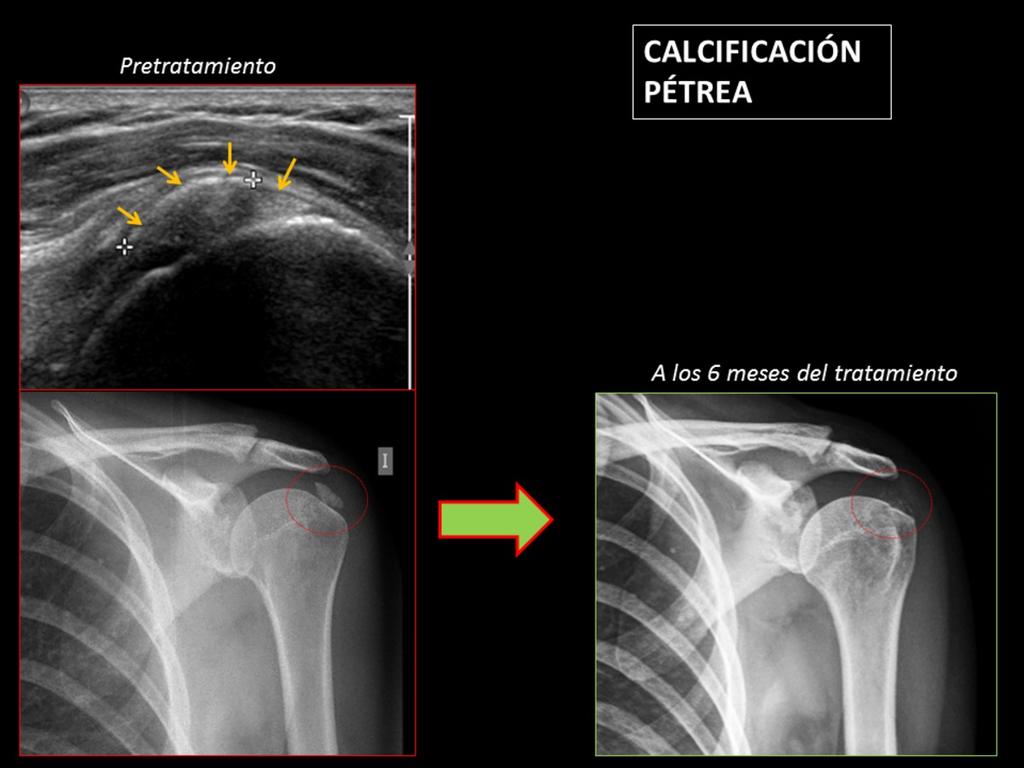 Fig. 6: Imágenes de ecografía y radiografía AP de hombro izquiedo pretratamiento, que muestran una calcificación pétrea (flechas amarillas) en el tendón